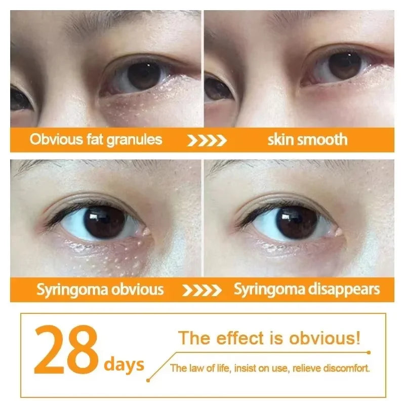 Fat Granules Remover Eye Cream Anti Puffiness Inflammatory Firm Cream Reduce Dark Circle Fade Fines Line Repair Barrier Eye Skin
