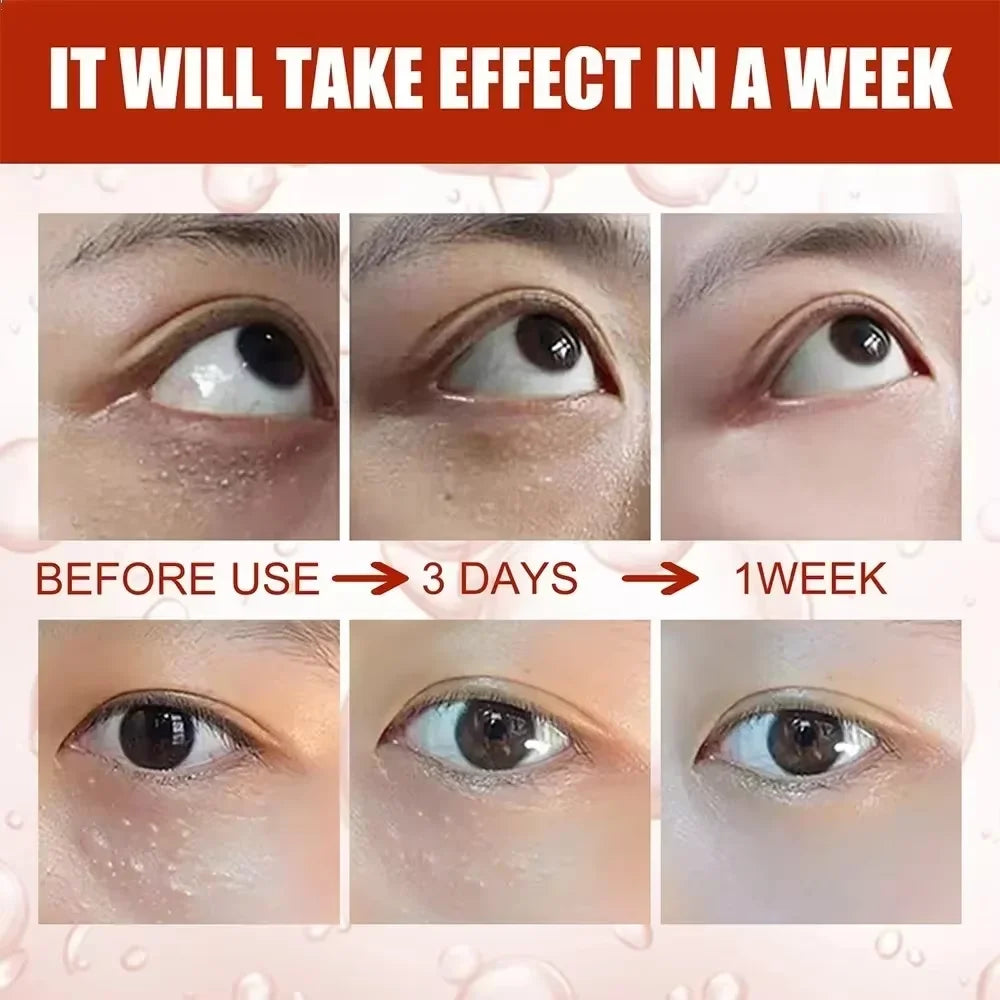 Fat Granules Remover Eye Cream Anti Puffiness Inflammatory Firm Cream Reduce Dark Circle Fade Fines Line Repair Barrier Eye Skin